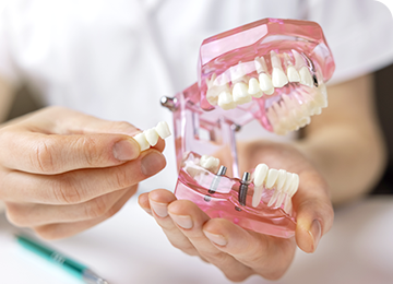 インプラント【安心の永続的解決法】